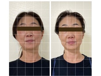 シャンタイン(SANTAI)/美顔器リフト★小顔