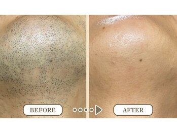 ビシルク(美 Silk)/ヒゲ脱毛　[静岡/草薙/清水区]