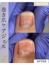 巻き爪ケア