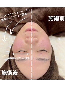 クリアーズ カグラザカ(CCLEAR'S KAGURAZAKA)の写真/確かな技術の小顔コルギで理想のフェイスラインへ！幹細胞美容液導入で輝く美肌へ導きます◎