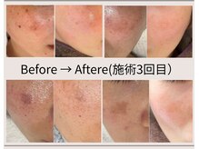 サロン マリー(SALON MARIE)の雰囲気（【濃いシミ・薄いシミ・か○ぱん】あらゆる肌悩みに効果大◎）