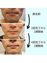 ワイズサロン(Y's salon)/脱毛4回目での効果！