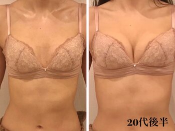 リール 新宿店(RIRE)/20代後半 バストアップ症例