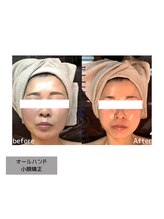 ブルームーン(BLUE MOON)/小顔矯正オールハンドエステ
