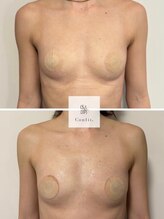 エムクリニカルラボ 藤沢(M clinical lab)/脂肪増加剤導入バストケア