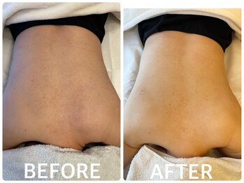 ハーブピーリング 恵比寿/肌質改善ハーブピーリング