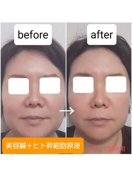 エルアンドエス(L&S)/美容鍼＋ヒト幹細胞原液