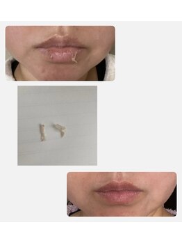 リアプア(Li'a)/ローマピンク【唇】皮むけ