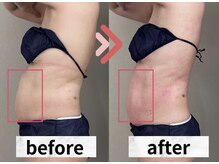 イヨヨ(iyoyo)/【痩身】Before After