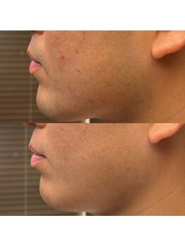 フェリーバ(FELIVA)/Before&After