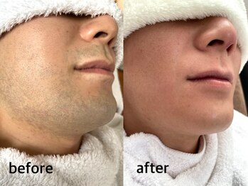 ブロンズ(Bronze)/ひげ脱毛　ビフォーアフター