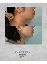 コンクパール(CONCH PEARL.)/マイクロ波リフト