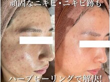 ホワイトアクア 加古川店(WHITE AQUA)の雰囲気（芸能人御用達★ダウンタイムなしハーブピーリングで肌質改善!）