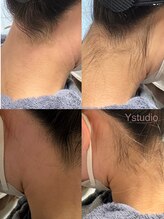 ワイスタディオ(Y studio)/【大人気】うなじワックス脱毛