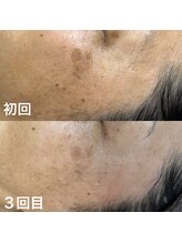 オードリー(Audrey)/3か月で驚異の変化！
