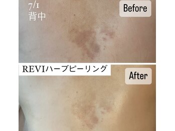 リフレ(Refre)/背中ハーブピーリングも大人気！