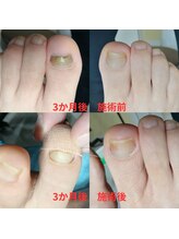 ドクターネイル爪革命 長野店/【肥厚・変形爪】ネイル/フット