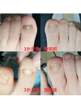 【肥厚・変形爪】ネイル/フット