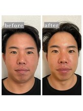 サロン ケー(Salon K)/EMSお顔引上げ【befor＆after】