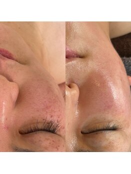小顔フェイスラボ 鈴鹿店(小顔FaceLabo.)/◆シミ改善◆