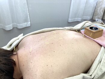 鍼灸院ゆうゆうの写真/【取れない腰の痛み・慢性的な腰のつらさを根本改善！】お客様に最適な鍼灸で快適な身体を取り戻そう♪