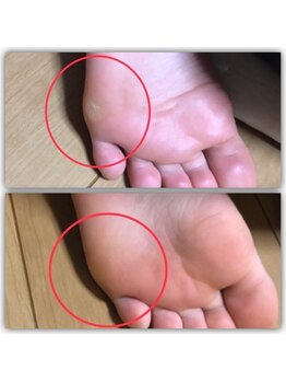 ララ(LARA)/足のまめ