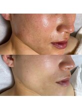 マリリン(MARILYN)/毛穴ケアで開きもキュッと♪