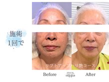 ディアスマイル(Dear.smile)/施術1回で