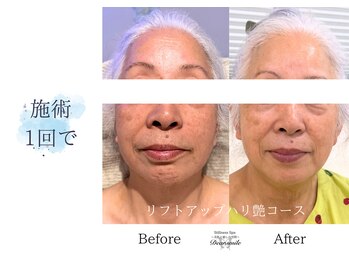 ディアスマイル(Dear.smile)/施術1回で