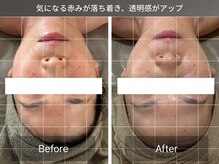 リラケア 三郷店/赤みが落ち着き透明感UP