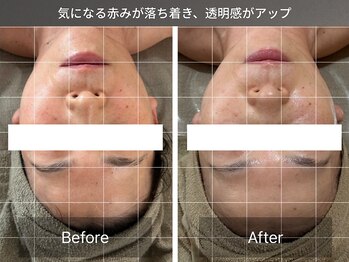リラケア 三郷店/赤みが落ち着き透明感UP