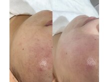 イム(im)/フェイスワックス脱毛