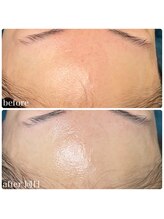 ちらちゅら/乳酸菌＋ハーブピーリング