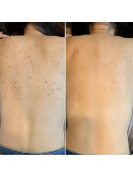 美肌研究所 東京新宿支店/背中の症例