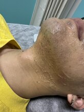 星空脱毛/最強メンズヒゲ脱毛