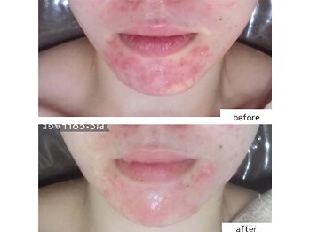 アンジェリーク/メグミ絶賛肌育ハーブピーリング