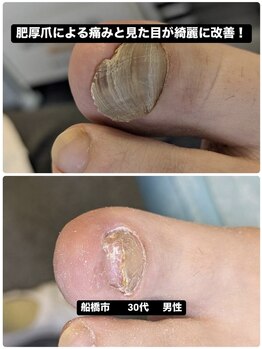 巻き爪じゅん 船橋店/肥厚爪の痛み見た目が改善