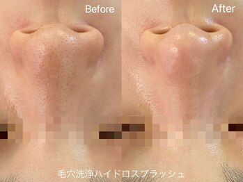 リアン(Lien)/毛穴洗浄ハイドロスプラッシュ