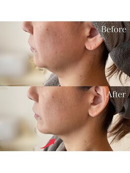 グレーシス(Graces)/韓国で大注目のチタニウムリフト