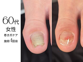 フットケア クラッシー(footcare classy)/少しづつ改善してます♪