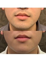 フェリーバ(FELIVA)/Before&After