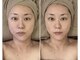 リム ビューティー(RYM BEAUTY)の写真/現在話題急上昇!サーマトリックス導入キャンペーン中！あなたに合わせたパーソナルフェイシャルで美肌/小顔