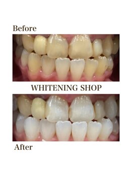 ホワイトニングショップ 一関店/5回照射後のbefore→after