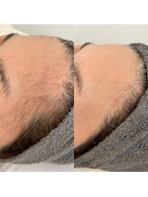 グレーシス(Graces)/顔脱毛