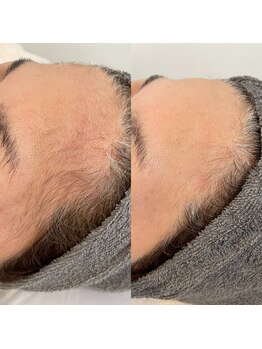 グレーシス(Graces)/顔脱毛