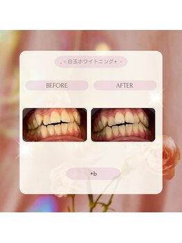 プラスビー 2号店(+b)/ホワイトニングビフォーアフター