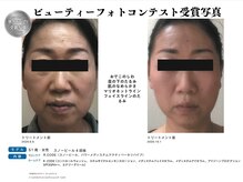 アドミーロ/ホワイトスノー4回＋ホームケア