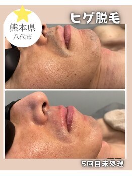 エスプラス エヌプラス(S+/N+)/脱毛で美肌もGET