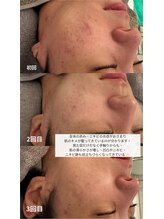 ニコ(nico)/ニキビが出来づらい肌へ