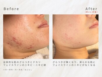 メレ(mele)/20代赤み／ニキビケア・毛穴